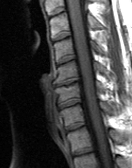 cervical 2 artrosis