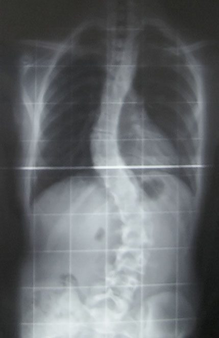 escoliosis 2