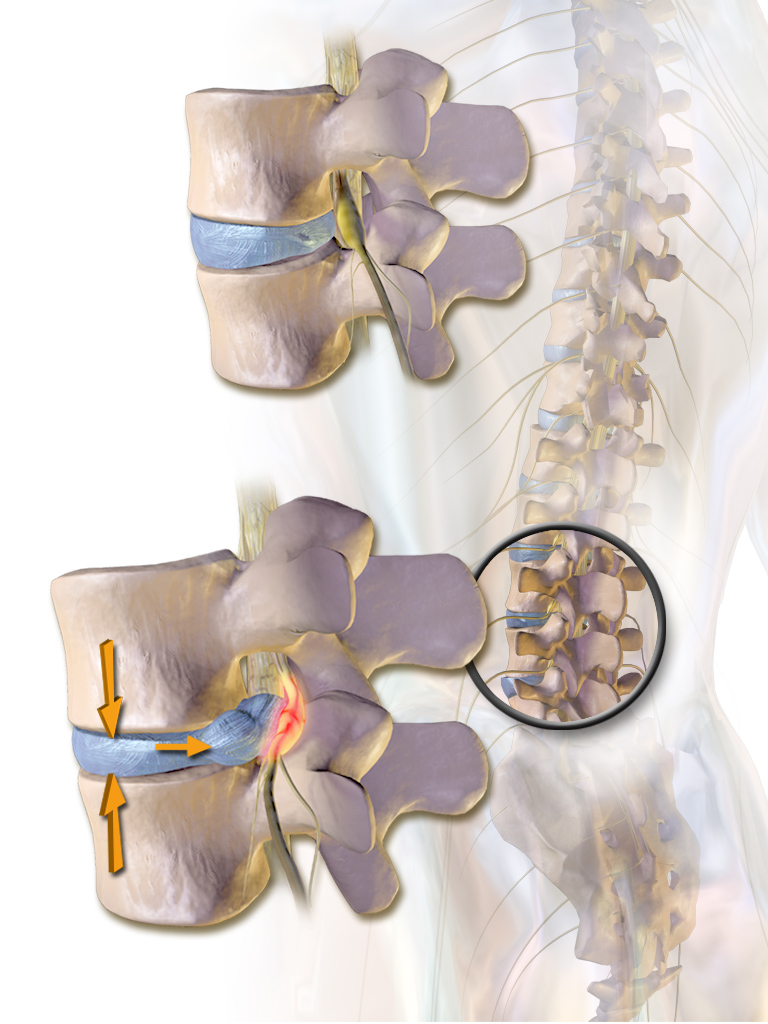 hernia 2