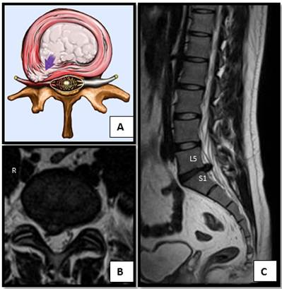 hernia 3