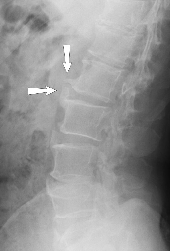 lumbar 3 min